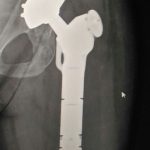Hip & femur replacement before traveling to Thailand